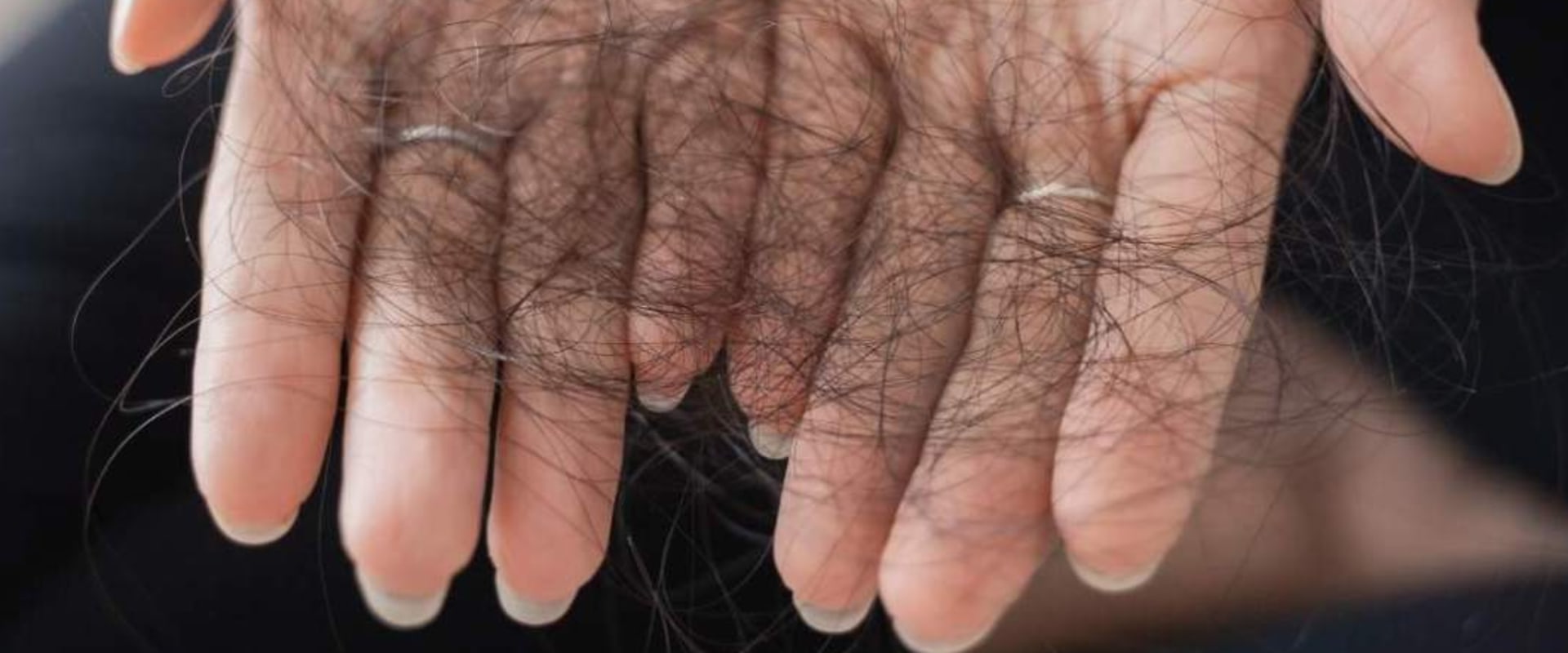 Hormonal Imbalances and Hair Loss: Understanding the Connection
