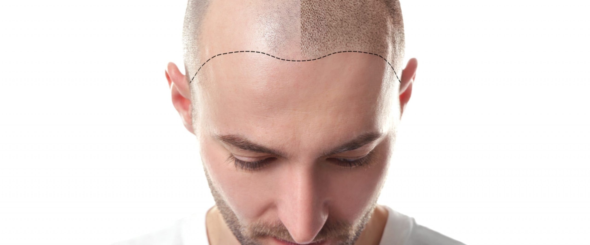 Scalp Camouflage Techniques for Seniors: A Guide to Hair Loss Treatments and Solutions
