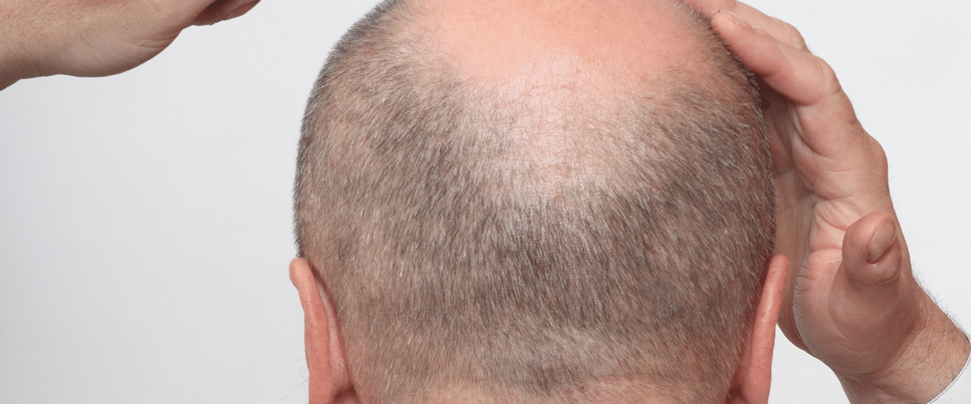 Understanding Alopecia: A Comprehensive Guide to Senior Hair Loss