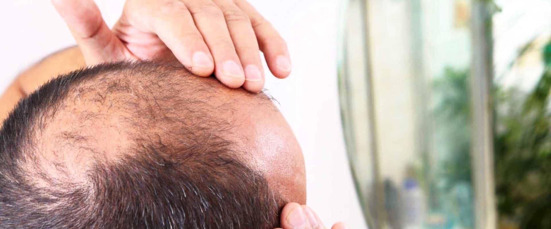 Understanding Male Pattern Baldness: Causes, Genetics, and Care for Seniors