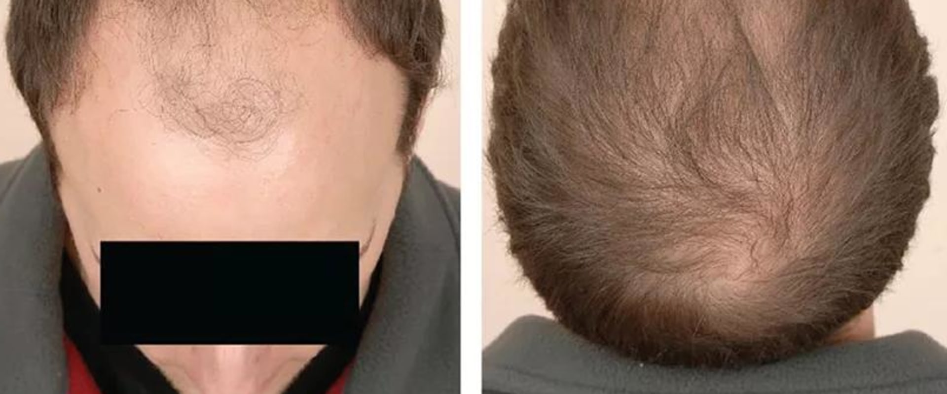 A Comprehensive Guide to Diagnosing Male Pattern Baldness