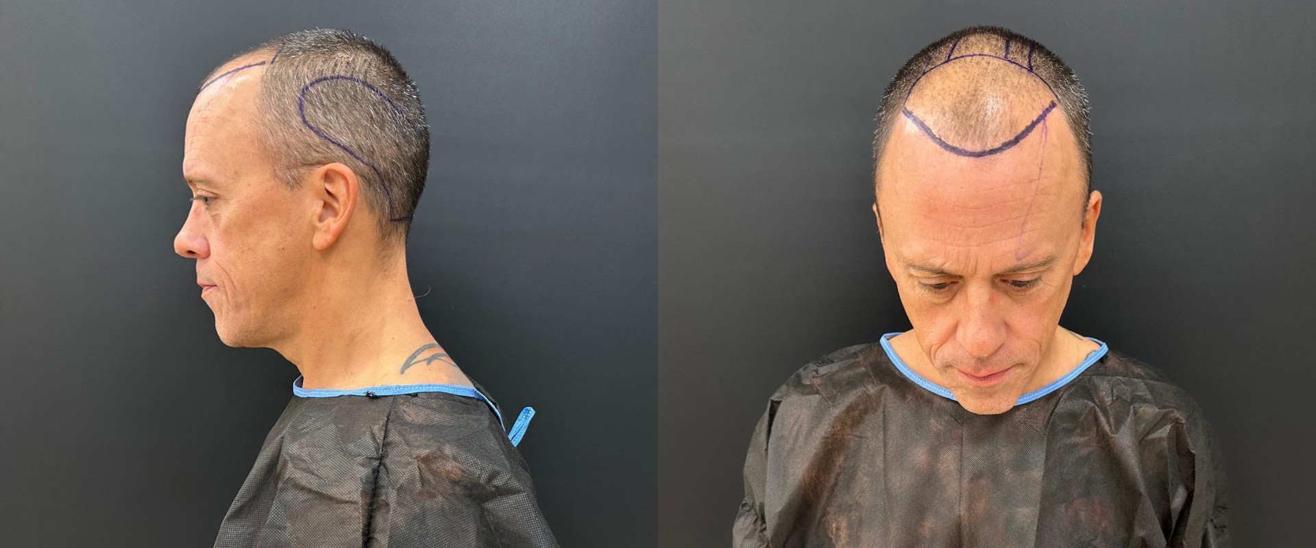 Understanding Hair Transplants for Seniors