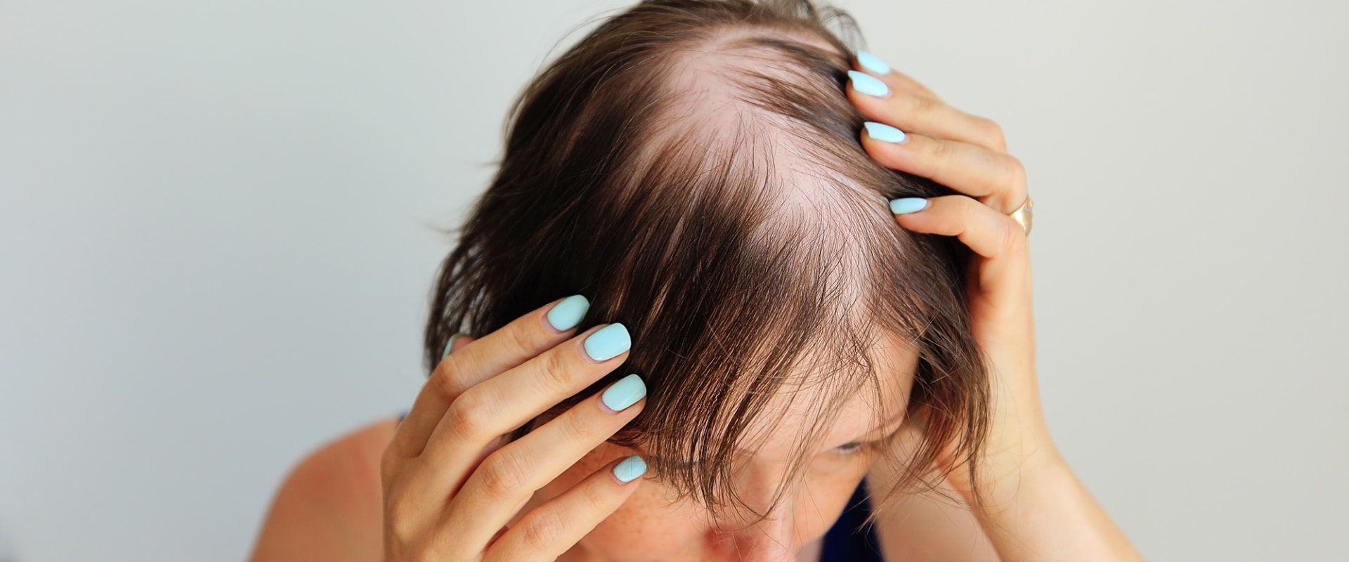 Diagnosing Female Hair Loss: A Guide to Understanding and Treating Hair Loss in Women