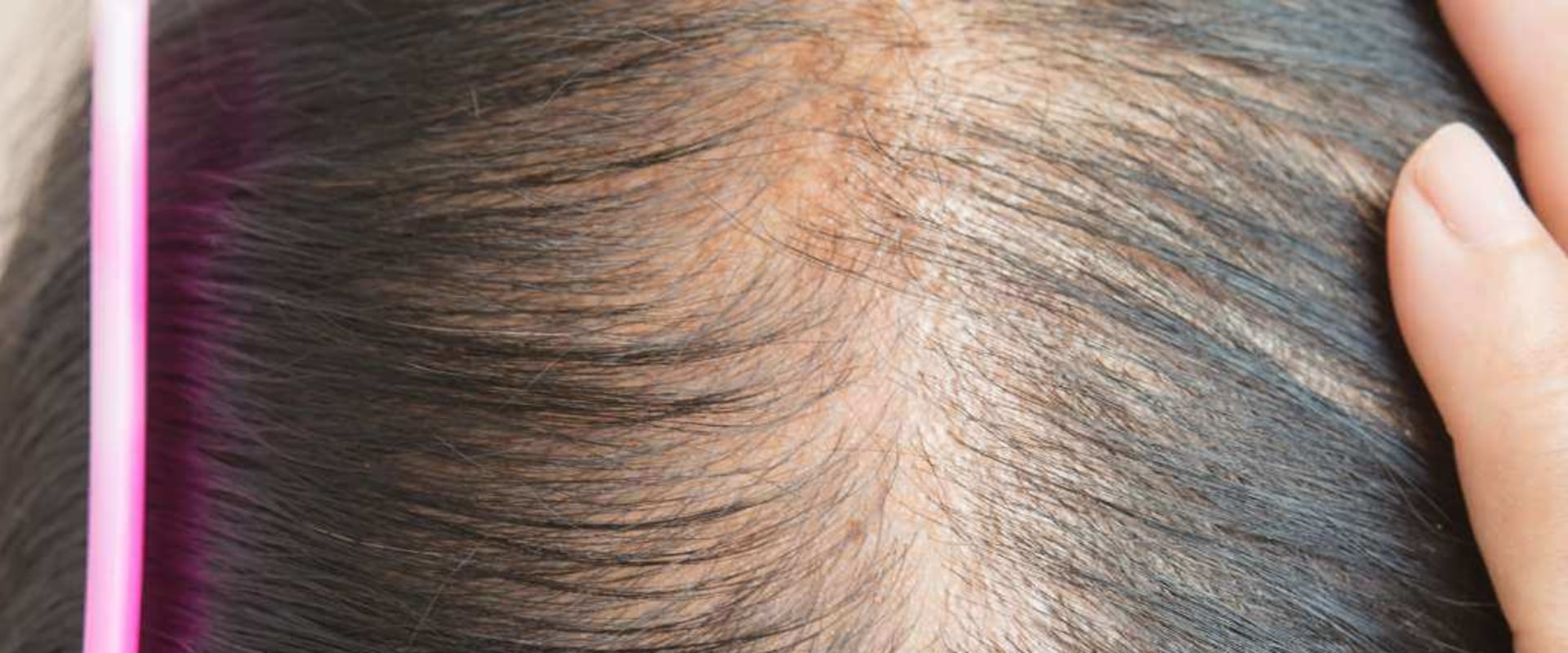 Understanding Iron-Deficiency Anemia and Hair Loss