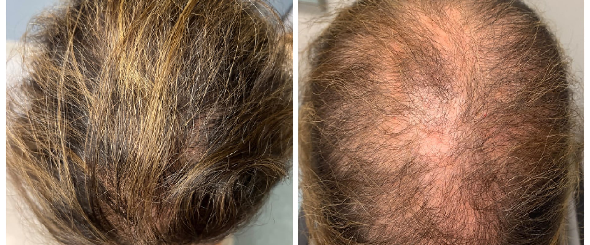 Natural Remedies for Male Pattern Baldness: How to Maintain Senior Health and Well-Being