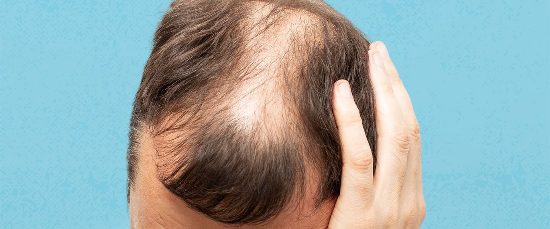 Lifestyle Factors and Male Pattern Baldness: Understanding the Connection