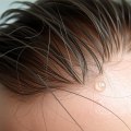 Understanding Minoxidil for Hair Loss: A Comprehensive Guide