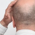 Understanding Alopecia: A Comprehensive Guide to Senior Hair Loss