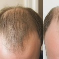 Understanding Medical Treatments for Male Pattern Baldness