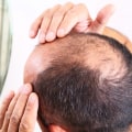 Understanding Male Pattern Baldness: Causes, Genetics, and Care for Seniors