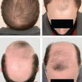 A Comprehensive Guide to Diagnosing Male Pattern Baldness