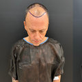 Understanding Hair Transplants for Seniors