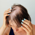 Diagnosing Female Hair Loss: A Guide to Understanding and Treating Hair Loss in Women