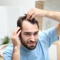 Genetics and Male Pattern Baldness: Understanding the Causes and Risks