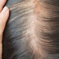Understanding Iron-Deficiency Anemia and Hair Loss