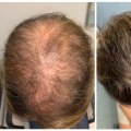 Natural Remedies for Male Pattern Baldness: How to Maintain Senior Health and Well-Being