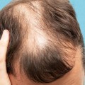 Lifestyle Factors and Male Pattern Baldness: Understanding the Connection