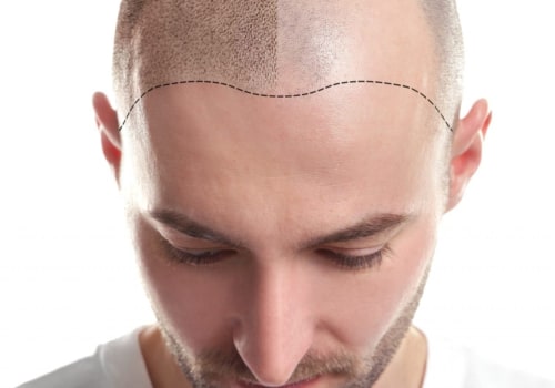 Scalp Camouflage Techniques for Seniors: A Guide to Hair Loss Treatments and Solutions