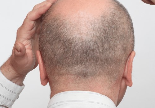 Understanding Alopecia: A Comprehensive Guide to Senior Hair Loss
