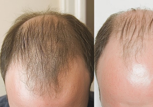 Understanding Medical Treatments for Male Pattern Baldness
