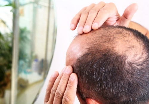 Understanding Male Pattern Baldness: Causes, Genetics, and Care for Seniors