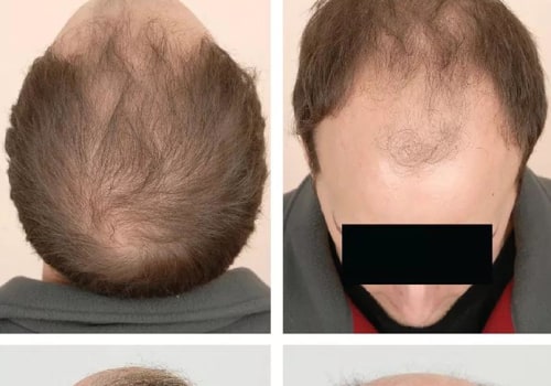 A Comprehensive Guide to Diagnosing Male Pattern Baldness
