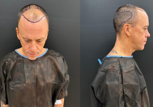 Understanding Hair Transplants for Seniors