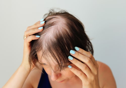 Diagnosing Female Hair Loss: A Guide to Understanding and Treating Hair Loss in Women