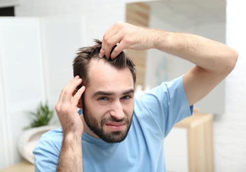 Genetics and Male Pattern Baldness: Understanding the Causes and Risks
