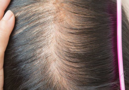 Understanding Iron-Deficiency Anemia and Hair Loss