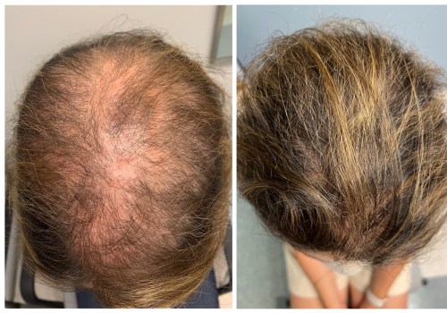 Natural Remedies for Male Pattern Baldness: How to Maintain Senior Health and Well-Being