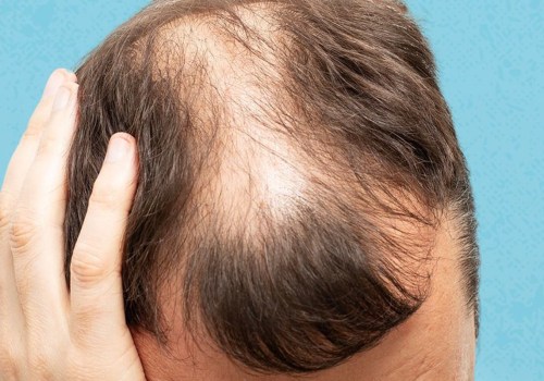 Lifestyle Factors and Male Pattern Baldness: Understanding the Connection